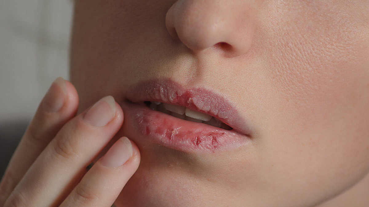 خشک ہونٹوں کا علاج کیا ہے؟