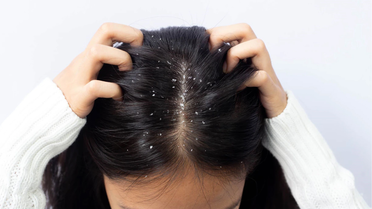 بالوں سے خشکی دور کرنے کے 5 طریقے