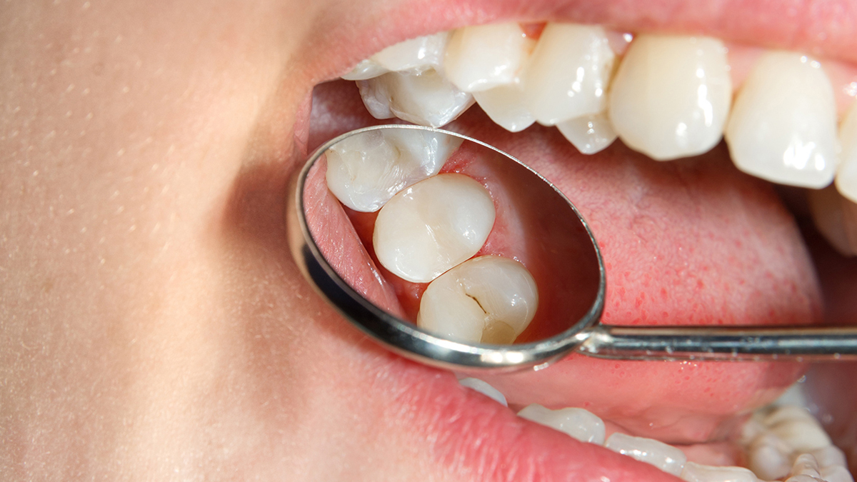 دانتوں میں کیڑا لگ جائے تو کیا کریں؟