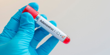 کراچی میں ایڈینو وائرس پھیلنے کا خدشہ محکمہ صحت کے حکام الرٹ