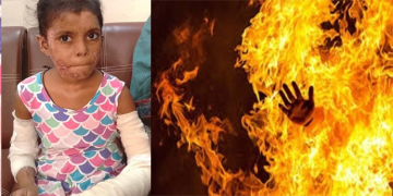 کراچی میں آٹھ سالہ بچی کو سوتیلے باپ نے آگ لگا دی، افسوسناک واقعہ