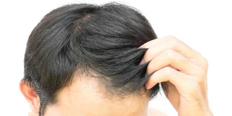 کیا شیمپو لگانے سے گنجا پن جلدی آتا ہے؟