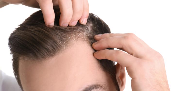 سر کے بالوں کی خشکی ختم کرنے کے دیسی ٹوٹکے