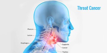 کیا مریم نواز کو گلے کا کینسر ہے؟